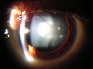 Cataract_in_Human_Eye
