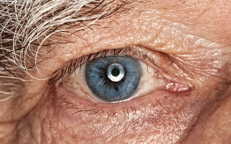 Eye MI LenSX Cataract Removal