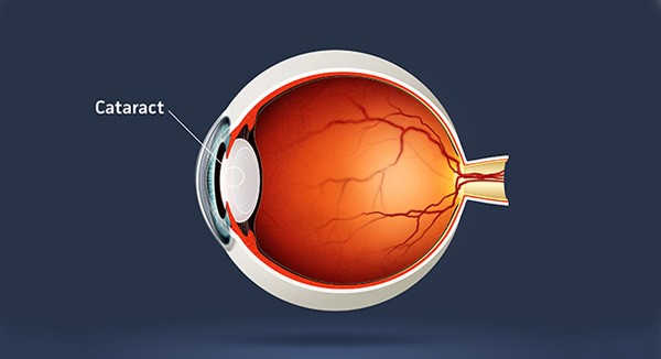 Eye Michigan Cataract Awareness