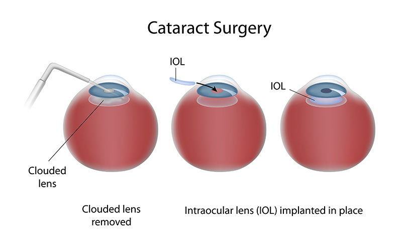 Eye Michigan Lasik Cataract Surgery