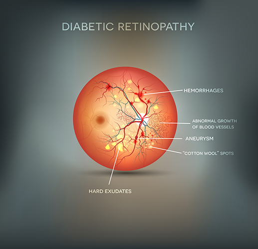 Eye Michigan Diabetic Retinopathy Treatment