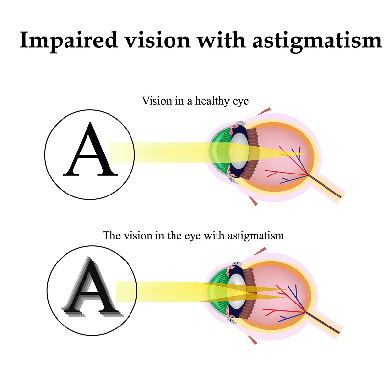 Eye Michigan Astigmatism Toric Lens Implant