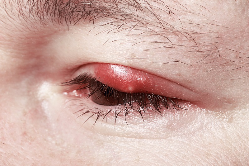 Eye Michigan Chalazion Treatment