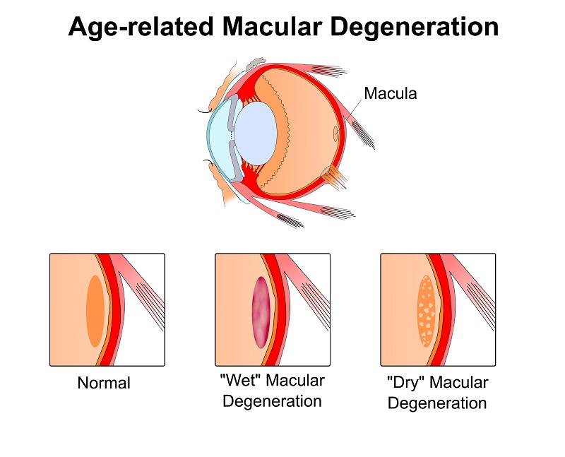 Eye Michigan Age Related Macular Degeneration February 2018