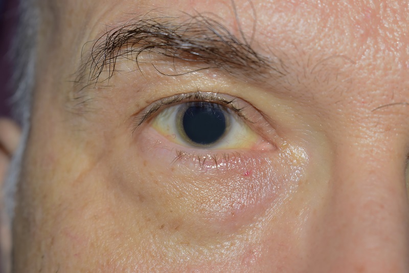 Eye Michigan Cornea Surgery