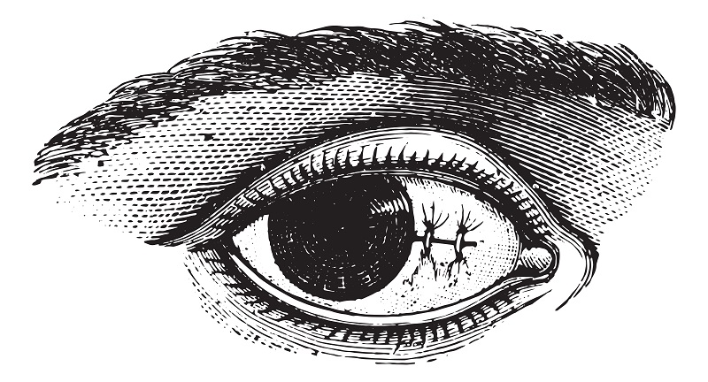 Eye Michigan Pterygium Surgery