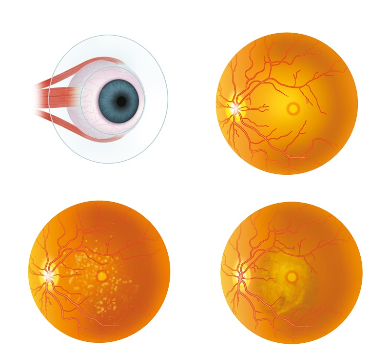 Eye Michigan Repairing Macular Holes