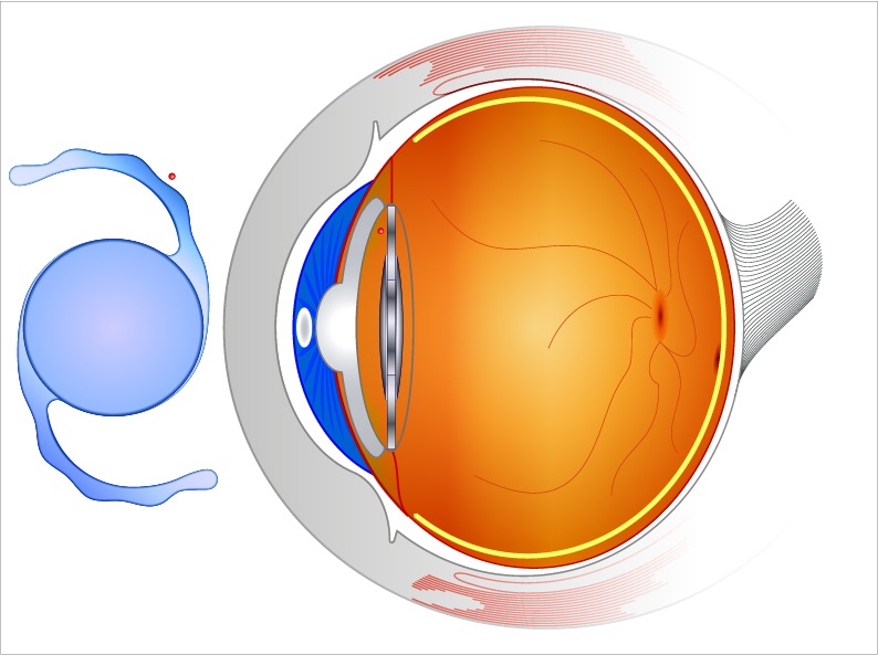 Eye Michigan Refractive Lens Exchange