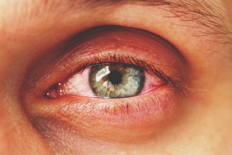 Conjunctivitis and COVID19 Grosinger, Spigelman & Grey