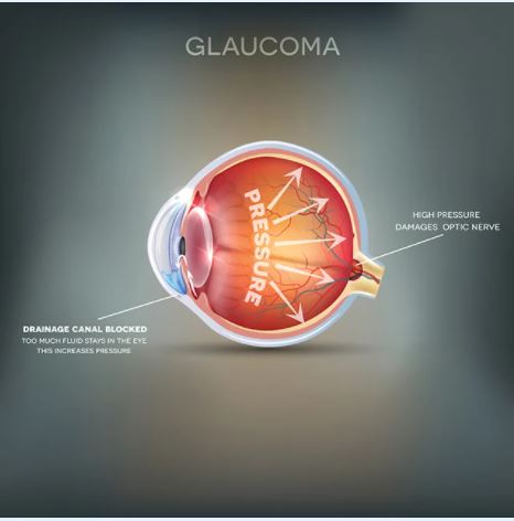 Grosinger Spigelman and Grey Open Angle Glaucoma Symptoms