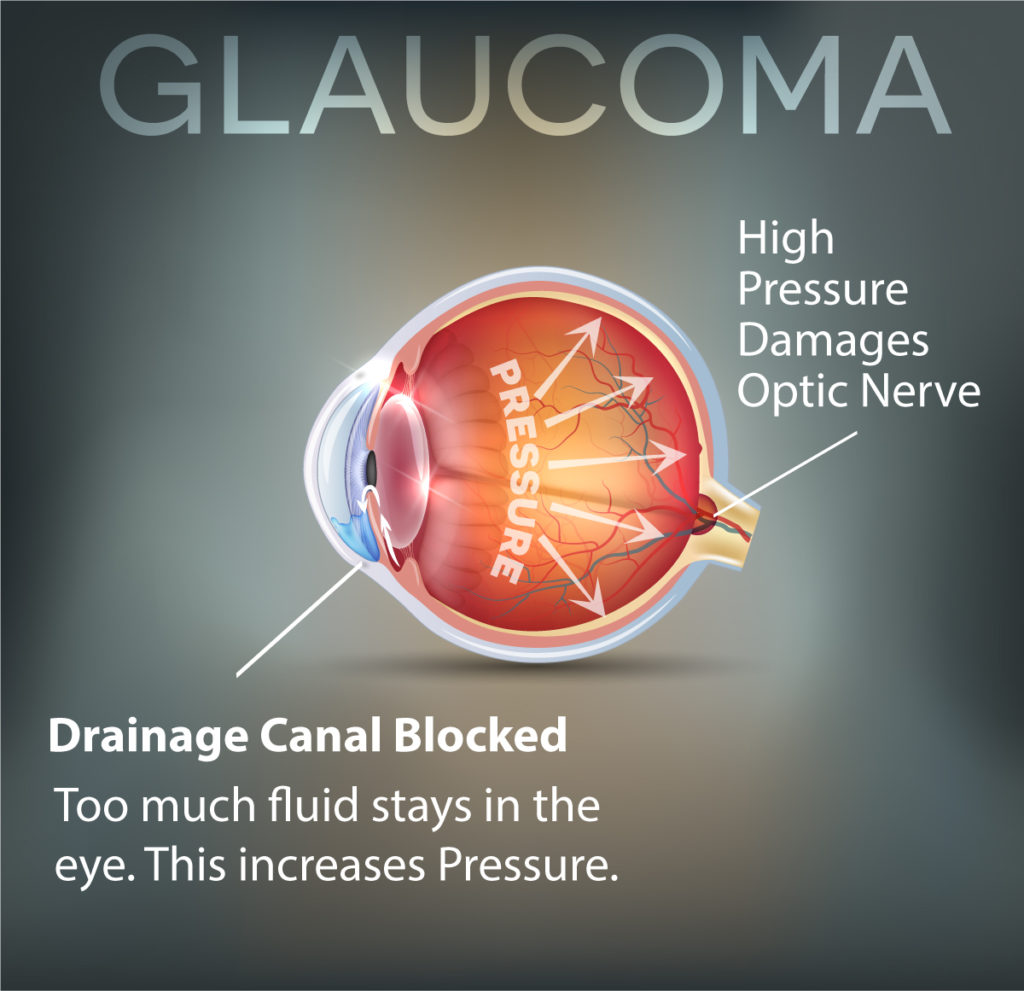 Glaucoma Diagram