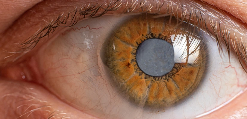 Cataract Surgery