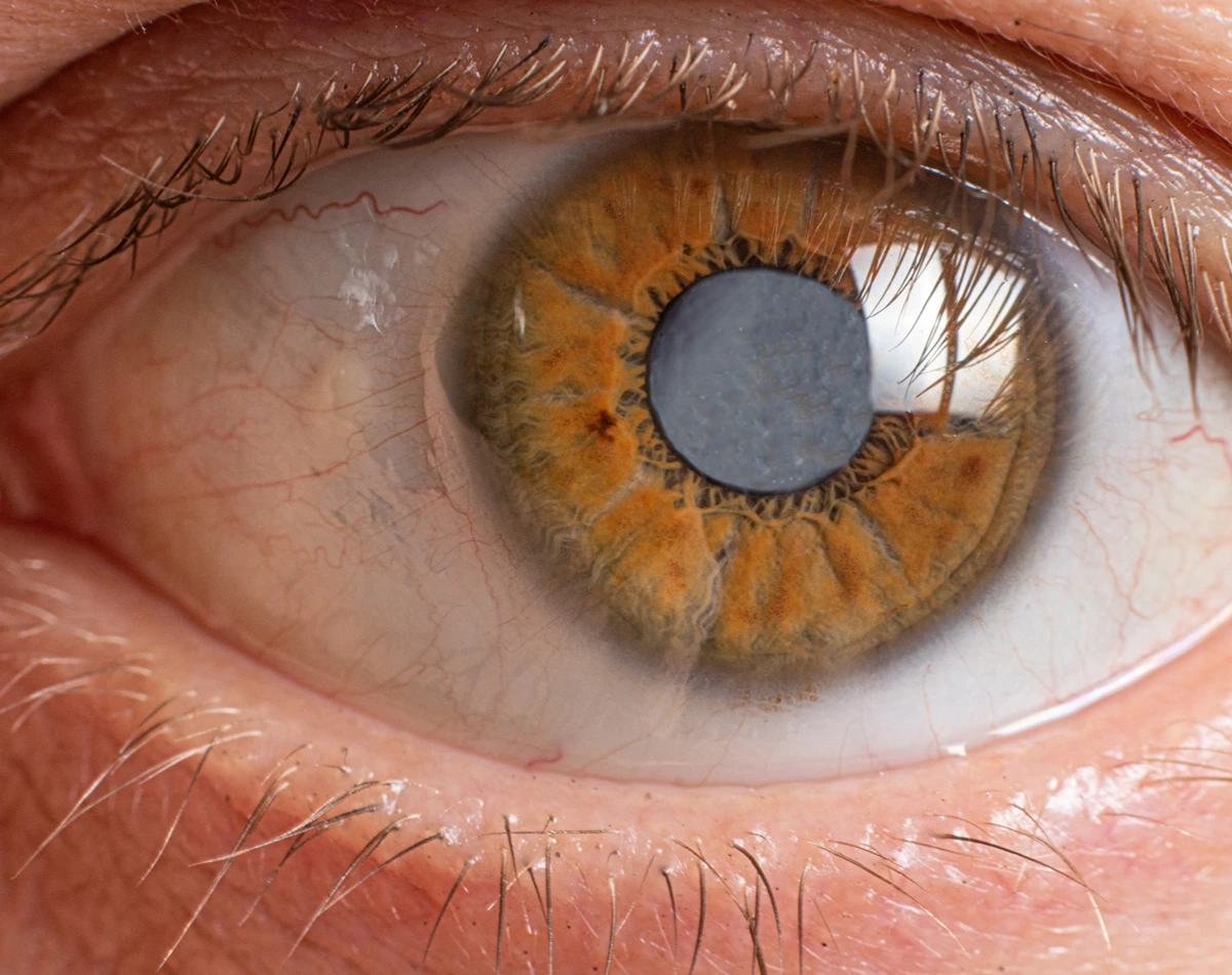 Cataract Surgery & Premium Lenses Specialist