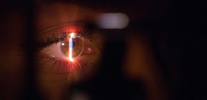 RLE & Clear Lens Extraction