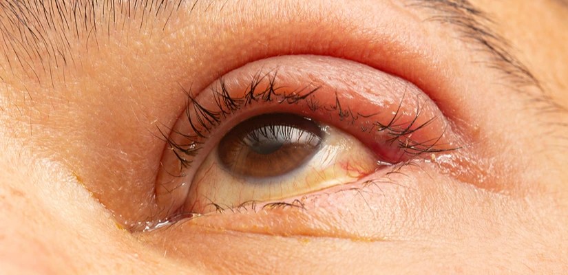 Styes & Chalazia Care